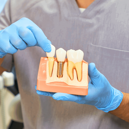 Implant Supported Restorations