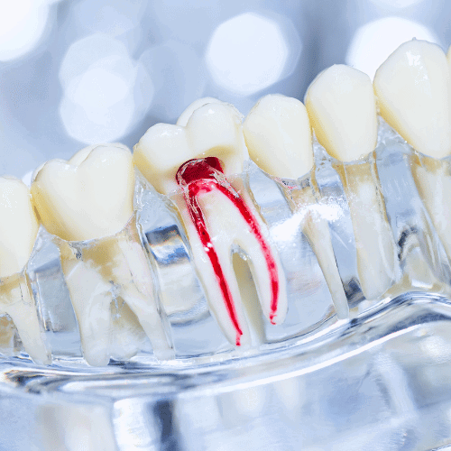 Root Canal Therapy