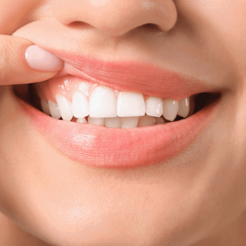 Teeth Whitening