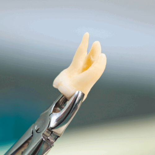 Teeth Extractions