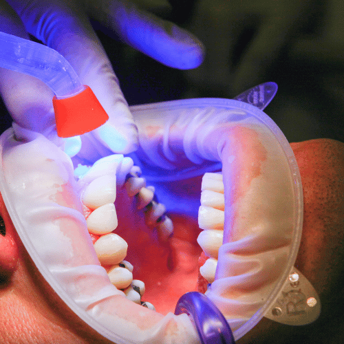 Teeth Fillings